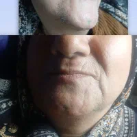الکترولیز موهای سفید و سیاه پراکنده