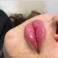 اف خدمات زیبایی ژل چال‌گونه پیرسینگ مژه