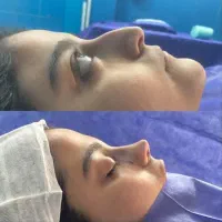 جراحی زیبایی بینی صفرتاصد ۲۹تومان متخصص(ent)|خدمات آرایشگری و زیبایی|تهران, یوسف‌آباد|دیوار