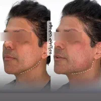 بمب تخفیف آموزش و خدمات فیلر و بوتاکس و مزو
