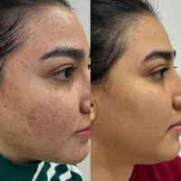 معجزه پوست مزو تخصصی