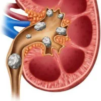 درمان سنگ کلیه بدون لیزر
