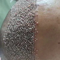 تخفیف ویژه کاشت مو و ابرو