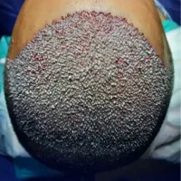 جشنواره ویژه کاشت تخصصی موشیرازی ۸میلیون باضمانت|خدمات زیبایی و سلامت|تهران, پاسداران|دیوار