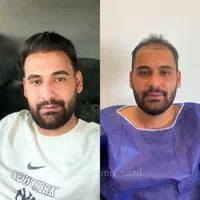 کاشت مو تضمینی و اقساطی در محیطی کاملا vip|خدمات آرایشگری و زیبایی|یزد, |دیوار