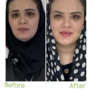 کانتورینگ فول فیس ، بوتاکس،لیزر ، ژل وفیلر ،فیشال|خدمات آرایشگری و زیبایی|فردیس, شهرک ۱۱۰|دیوار