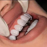 زیبایی لبخند با خدمات حرفه‌ای دندانپزشکی در پردیس|خدمات آرایشگری و زیبایی|بومهن, |دیوار