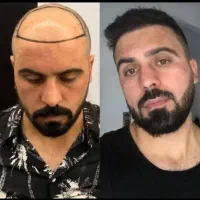 جشنواره کاشت مو یک روزه فول تراکم|خدمات آرایشگری و زیبایی|تهران, دزاشیب|دیوار