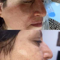 ازببن بردن کک ومک در یک جلسه