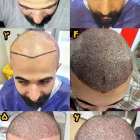 موبکاربعداپولشوبده|خدمات زیبایی و سلامت|تبریز, |دیوار
