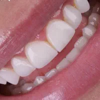 افر تابستانه کامپوزیت دندان متریال در جه یک .|خدمات آرایشگری و زیبایی|کرج, گلشهر|دیوار