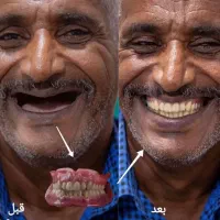 دندان مصنوعی دندانسازی بامجوز رسمی و ۵۰درصدتخفیف