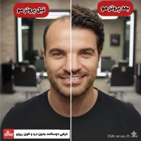 پروتز مو نیوزلندی تولید کشور هند