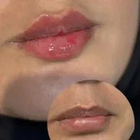 پکیج تخفیفی تزریق ژل و بوتاکس و مزوژل و آموزش