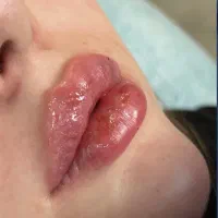 فیلر بوتاکس