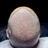کاشت‌مو/ژل/بوتاکس