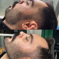 جشنواره پاییزه فیلر لب ژللب بوتاکس زاویه فک گونه|خدمات آرایشگری و زیبایی|کرج, مطهری|دیوار