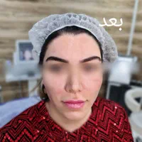 (کلینیک دنا) تنها هایفو۱۲بعدی یاسوج|خدمات آرایشگری و زیبایی|یاسوج, |دیوار