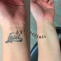 لیزر مو زائد وتتو فیلر ژل بوتاکسprp پاکسازی فیشیال|خدمات آرایشگری و زیبایی|اهواز, گلستان|دیوار