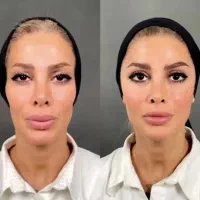 جشنواره بوتاکس مزو فیلر بادی بینی لب جراحی نیاوران|خدمات زیبایی و سلامت|تهران, دزاشیب|دیوار