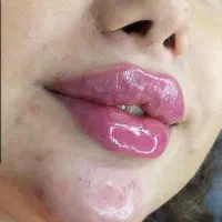 لیزر/جوانساز/تزریق فیلرلب وچانه وژل/رفع غبغب