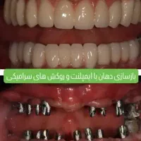 شرایط ویژه جشنواره دندانپزشکی ایمپلنت و اوردنچر|خدمات آرایشگری و زیبایی|آذرشهر, |دیوار