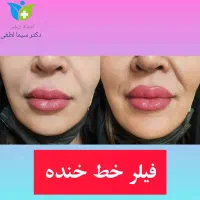 تزریق ژل بوتاکس جوانسازی پی آر پی کربوکسی و لاغری|خدمات آرایشگری و زیبایی|قزوین, |دیوار
