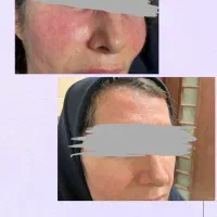 جشنواره ژل گونه، چانه، زاویه فک و لب|خدمات زیبایی و سلامت|تهران, میدان ولیعصر|دیوار