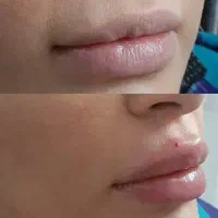 تزریق ژل و بوتاکس توسط دستار پزشک