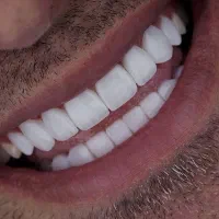 دندانپزشکی،ایمپلنت،اوردنچر با اقساط دو ساله