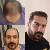 کاشت مو و ابرو به روش انحصاری خانم دکتر فرح آل قیس