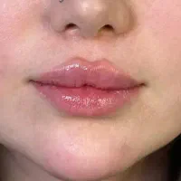 تزریق ژل (فیلر)مدل لب بوتاکس پیرسینگ