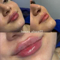 تخفیف استثنایی خدمات ژل فیلر بوتاکس|خدمات آرایشگری و زیبایی|کرج, گلشهر|دیوار