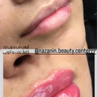 بوتاکس، فیلر و خدمات پیرسینگ|خدمات آرایشگری و زیبایی|رشت, خواهر امام|دیوار