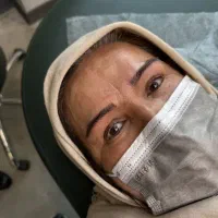 جذب مدل میکروبلیدینگ