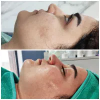 پاکسازی پوست،درمان منافذ باز،آکنه،تخلیه سر سیاه