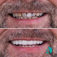 ایمپلنت و لمینت با سرامیک ژاپن