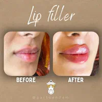فیلر ژل بوتاکس نخ لیفت و جوانساز زاویه هایفو