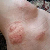 اگر درگیر اگزمای پوستی هستی من میتونم کمکت کنم