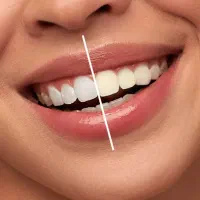 سفید کننده دندان|آرایشی، بهداشتی، درمانی|تهران, امامت|دیوار