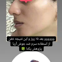 سرم نیاسینامید ضد لک وجوش|آرایشی، بهداشتی، درمانی|شیراز, باغ تخت|دیوار
