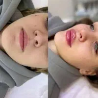 جشنواره ۵۰ درصدی ژل بوتاکس فقط تا سه روز