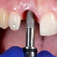 مدل برای ایمپلنت دندان