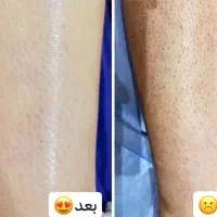 جدیدترین دستگاه لیزر 2025 در شهر جم|خدمات آرایشگری و زیبایی|جم, |دیوار