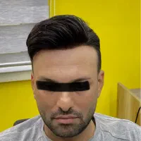 پروتز مو|آرایشی، بهداشتی، درمانی|تهران, نارمک|دیوار