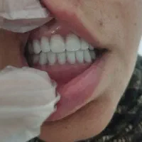 پروتز تحویل ۱ روزه به قیمت محلات