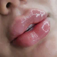 ژل لب و بوتاکس کراتین مو چال گونه(اف عیدانه)