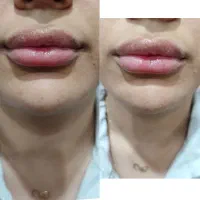 لیزر موهای زائد،ژل،بوتاکس،فیشال،پاک کردن تتو|خدمات آرایشگری و زیبایی|کرج, فاز ۴ مهرشهر|دیوار