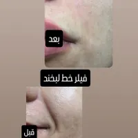 تزریق ژل با قیمت مناسب وبا کیفیت|خدمات آرایشگری و زیبایی|برازجان, |دیوار
