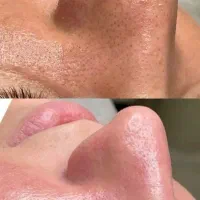 اموزش پاکسازی پوست